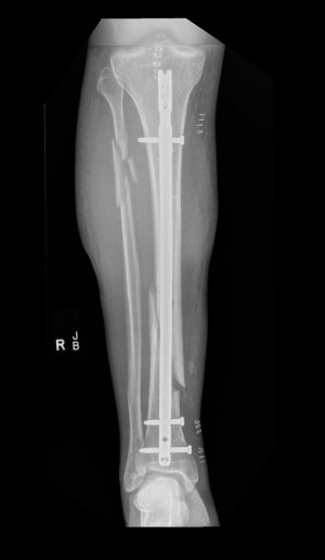 X-Ray post-surgery.jpg