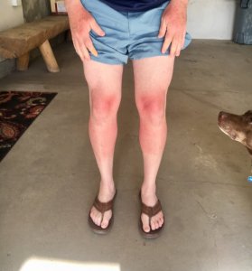 burned knees.jpg